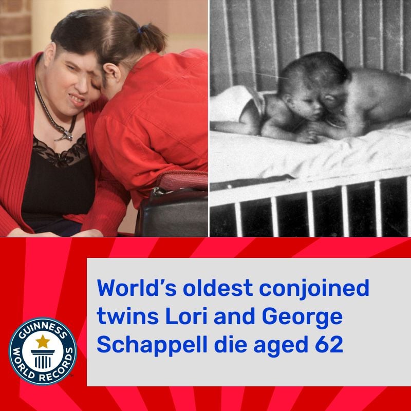 Lori et les jumeaux siamois les plus âgés au monde, sont décédés à 62 ans
